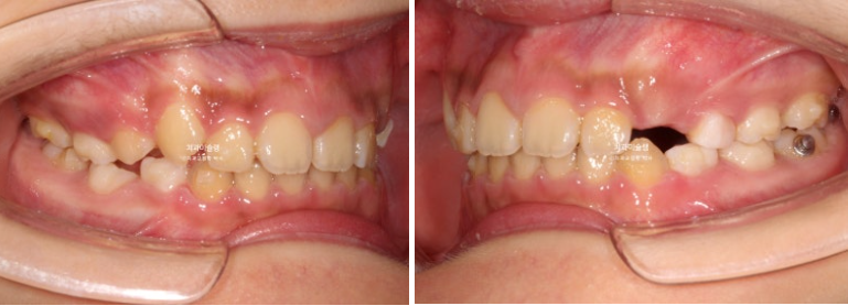 선천적 결손 잔존유치 과개교합 돌출입 인비절라인 퍼스트 어린이 투명교정 치료기간 관련 이미지 10