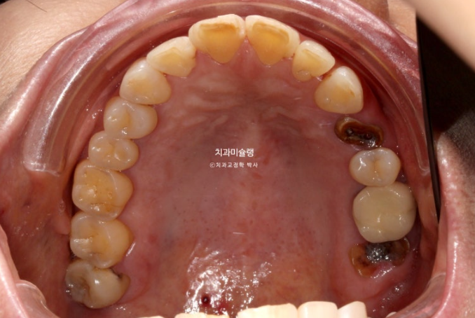 50대 치아교정 돌출 치아벌어짐 중년교정 관련 이미지 3