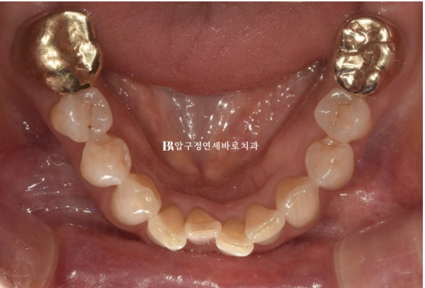 압구정 인비절라인|50대 앞니 부분교정부터 무삭제 라미네이트까지, 자연스러운 미소 완성 관련 이미지 5