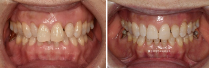 Can It Be Done in Your 50s? Real Results from Limited Front Teeth Orthodontics + No-Prep Laminate Veneers Revealed image 9