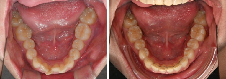 인비절라인 라이트 돌출 과개교합 중심선 교정 치간삭제 치료기간 관련 이미지 12