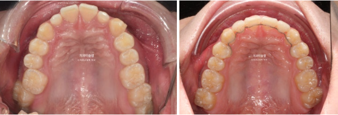 비대칭 비발치 거미스마일 잇몸미소 중심선 가위교합치료 무삭제 라미네이트 관련 이미지 22
