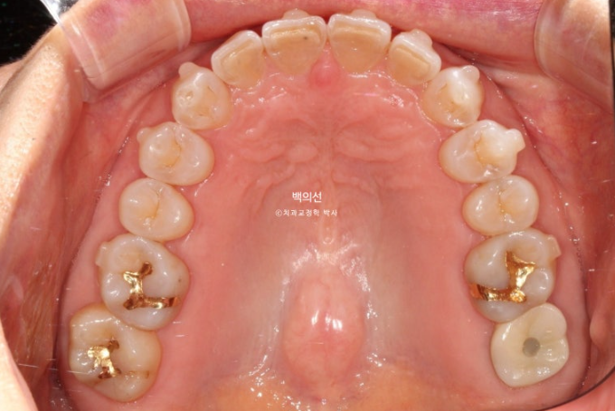 50대 치아교정 :: 인비절라인 익스프레스 치아 벌어짐 단기교정 후기 관련 이미지 11