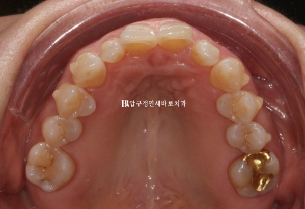 50s Invisalign Lite No-Prep Laminate Bunny Teeth image 7