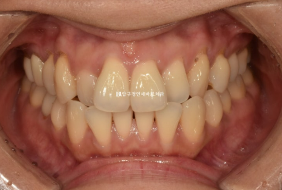 Gangnam Orthodontic Clinic: A Woman in Her 30s’ Rabbit Teeth Correction Review|Six-Month Front Teeth Partial Orthodontic Treatment That Also Improved a Crossbite image 2