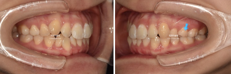 인비절라인 비발치 토끼이빨 교정 덧니 교정 치료기간 1년 8개월 관련 이미지 3