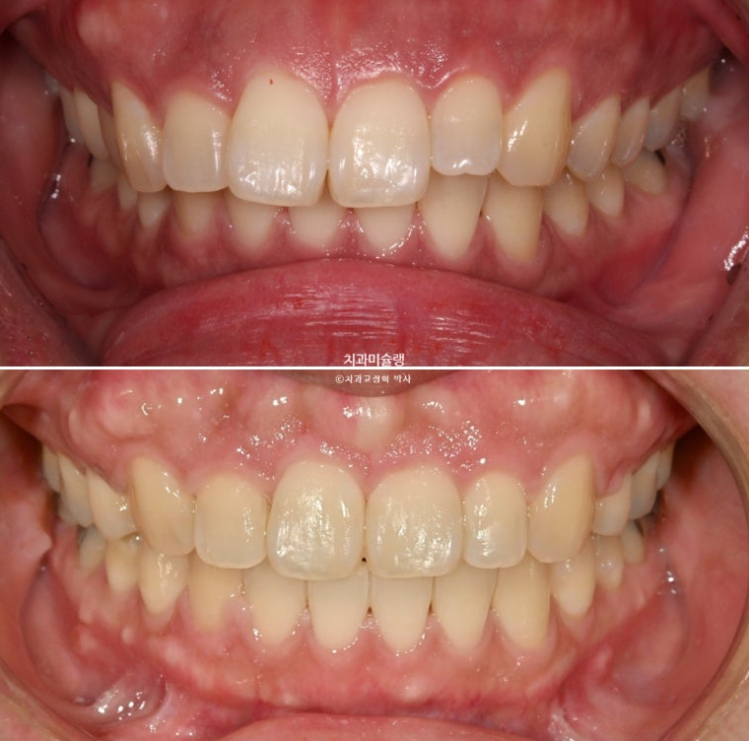 Extraction Orthodontics with Clippy-C for Protruding Mouth, Gum Smile, Gummy Smile Correction, and Treatment for a Recessed Chin image 14