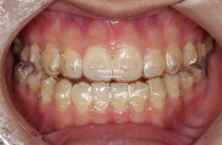 중학생 주걱턱 반대교합 개방교합 덧니 교정 인비절라인 후기 관련 이미지 6