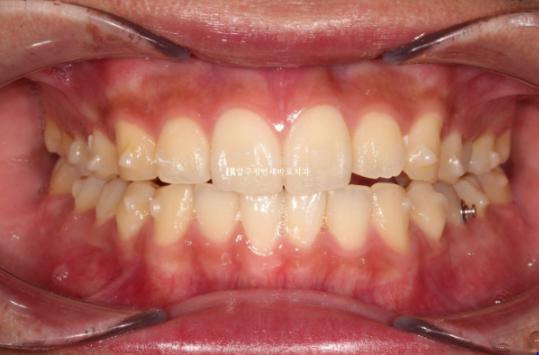 인비절라인 라이트 교정 덧니 이소맹출 반대교합 관련 이미지 6