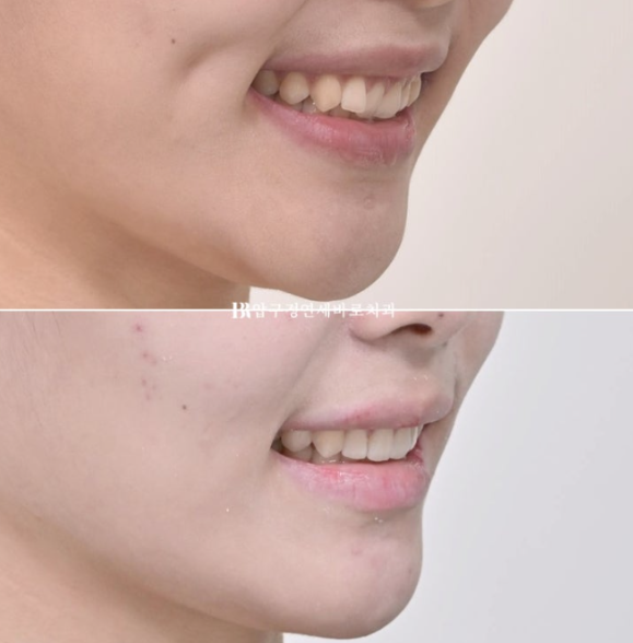 If Inward-Tilted Teeth Make Your Smile Look Constricted? Invisalign Before and After image 1