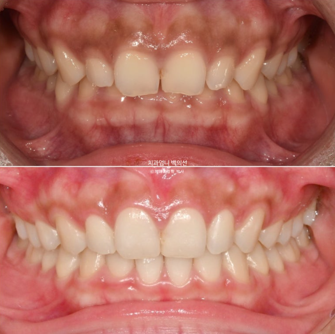 과개교합 옥니 거미스마일 교정 인비절라인 라이트 잇몸성형 후기 관련 이미지 16