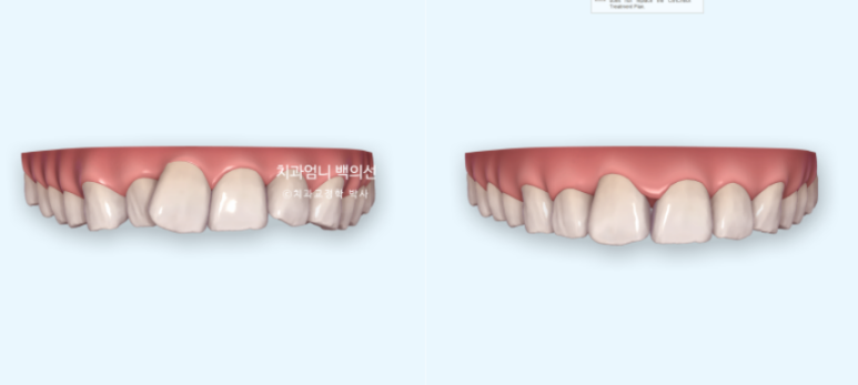 앞니 부분교정 덧니 교정 블랙트라이앵글 부정교합 마모 시뮬레이션 치료기간 5개월 관련 이미지 7