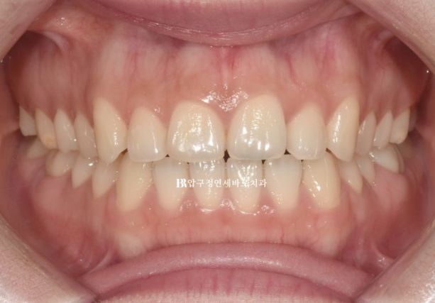 Before and After Non-Prep Veneers: Improving Gaps Between the Front Teeth and the Smile Line Together image 1