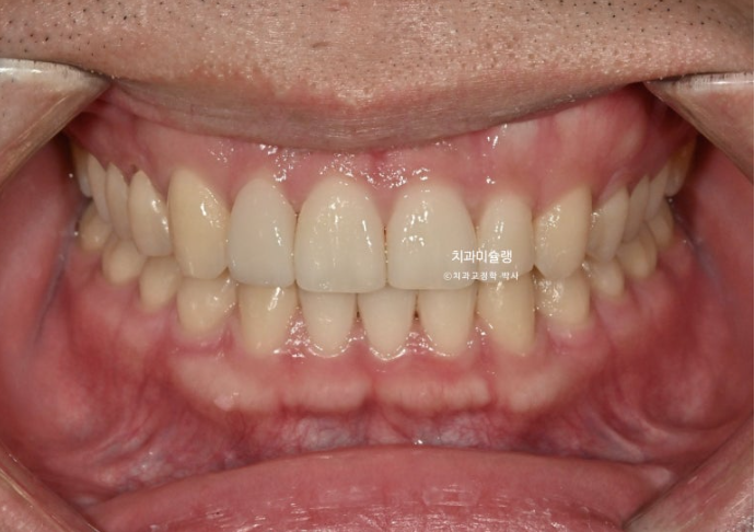 옥니 덧니 교정 왜소치 선천적 결손 3전치 무삭제 라미네이트 인비절라인 교정 관련 이미지 15