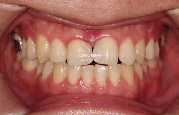MSE Palatal Expansion Invisalign Underbite Correction, Non-Surgical image 8