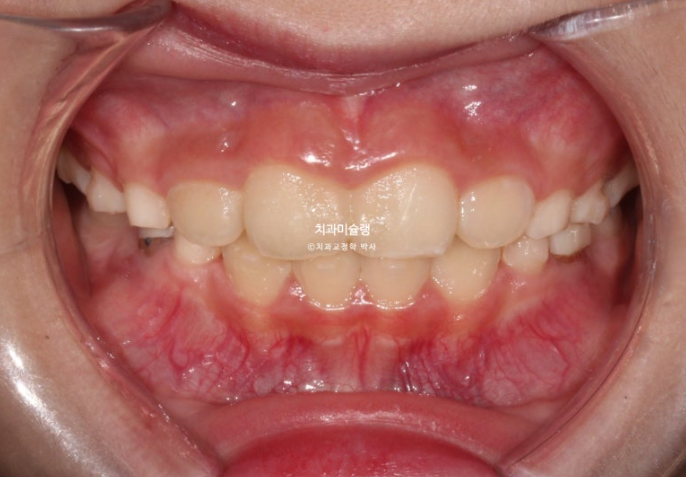 어린이 투명교정 인비절라인 퍼스트 과개교합 교정 후기 관련 이미지 6