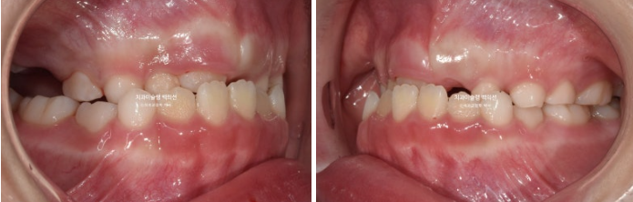 어린이 비대칭 반대교합 주걱턱 인비절라인 퍼스트 프리올소 성장 교정 관련 이미지 3