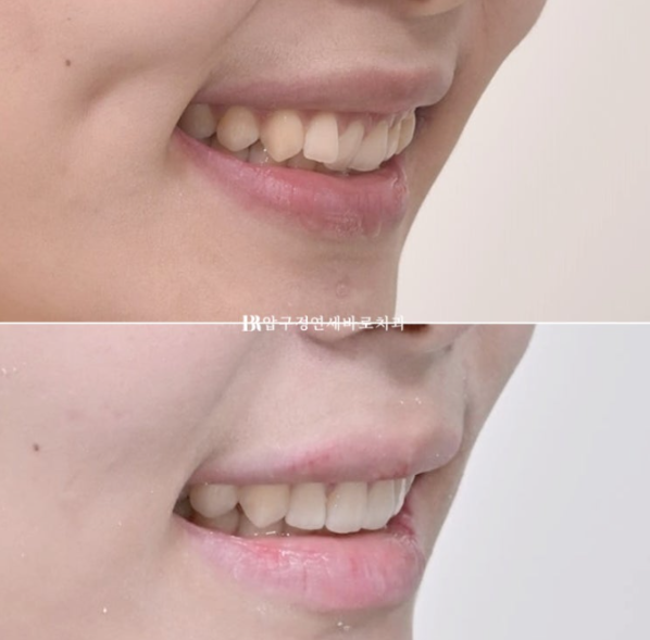 If Inward-Tilted Teeth Make Your Smile Look Constricted? Invisalign Before and After image 17