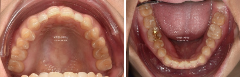 비수술 개방교합 클리피씨 30대 무삭제 라미네이트 치료기간 2년 관련 이미지 4