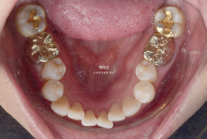 거미스마일 교정 돌출입 발치교정 입술부전 호두턱 치료기간 2년반 관련 이미지 5