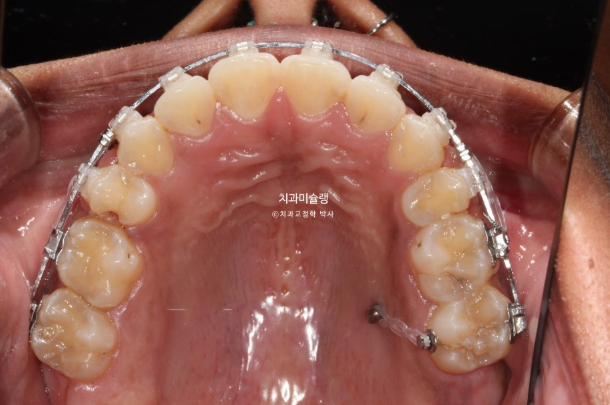 Extraction & re-orthodontics with Clippy-C, intrusion for dental implant. 관련 이미지 14