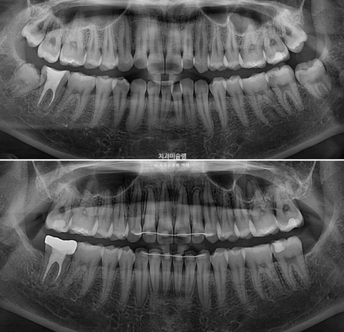 유학생 치아교정 해외거주 한국에서 치아교정? 관련 이미지 22