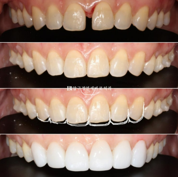 Can Gaps Between the Front Teeth Be Treated with No-Prep Veneers Alone? A Real Case Completed with Gelami After Invisalign Lite image 25