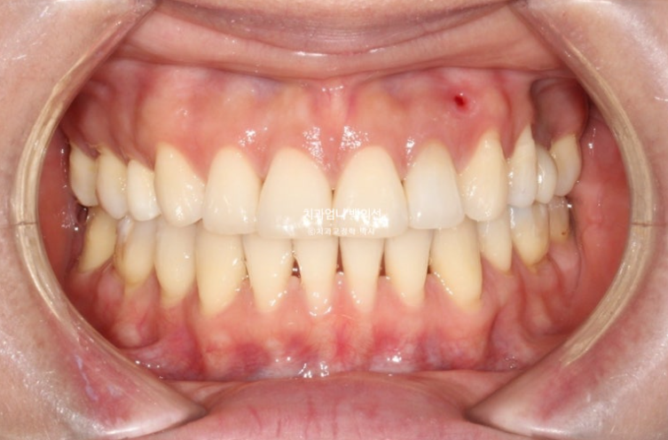 옥니 교정 역교정 재교정 무턱교정 치료기간 1년 10개월 관련 이미지 13