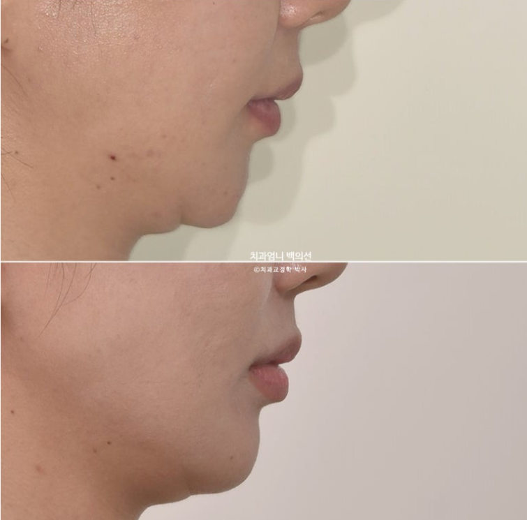 옥니 교정 역교정 재교정 무턱교정 치료기간 1년 10개월 관련 이미지 20