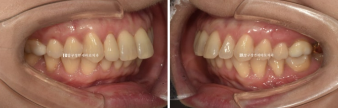 Invisalign Lite for Orthodontic Treatment in Your 40s: Crossbite and Protrusive Mouth Correction image 4