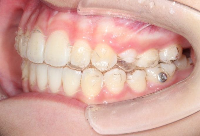 돌출입 비발치 어린이 교정 입술부전증 호두주름 호두턱 토끼이빨 인비절라인퍼스트 관련 이미지 12