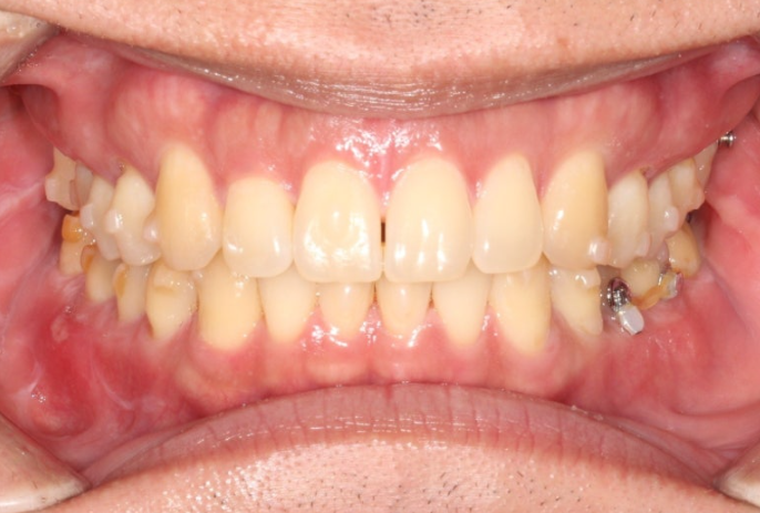 가위교합 벌어짐 중심선 과개교합 인비절라인 라이트 교정 관련 이미지 7