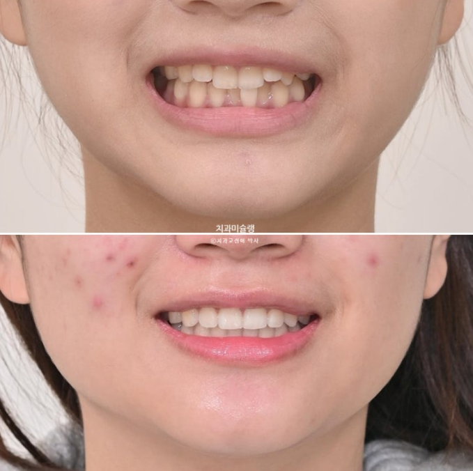 유학생 치아교정 해외거주 한국에서 치아교정? 관련 이미지 1