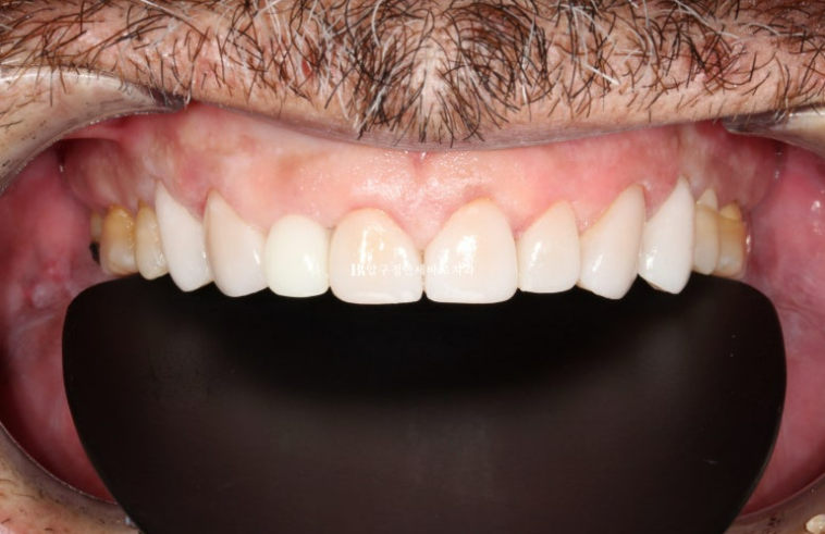 50대 중년교정 무삭제 라미네이트 중년 부분교정 후기 관련 이미지 7