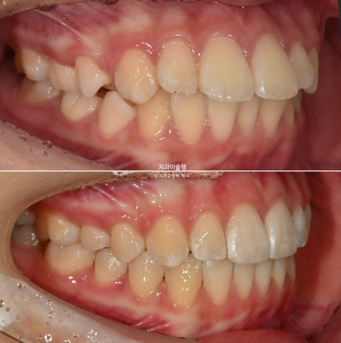 돌출입 비발치 어린이 교정 입술부전증 호두주름 호두턱 토끼이빨 인비절라인퍼스트 관련 이미지 19
