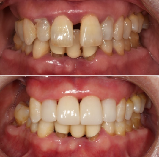A 60s Patient’s Orthodontic Treatment Review | A Case Combining Partial Orthodontics for the Front Teeth After Periodontitis Treatment with No-Prep Veneers image 9