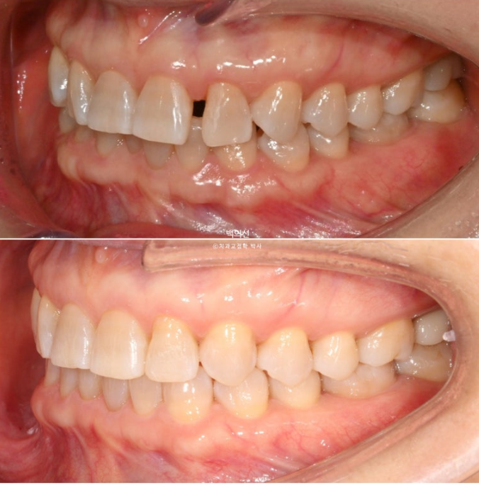50대 치아교정 :: 인비절라인 익스프레스 치아 벌어짐 단기교정 후기 관련 이미지 1