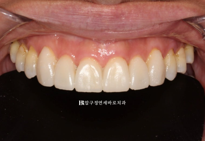 How to Avoid Regretting No-Prep Laminate Veneers: The Fitting Process Revealed image 3