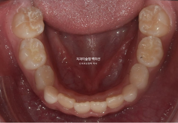 어린이 비대칭 반대교합 주걱턱 인비절라인 퍼스트 프리올소 성장 교정 관련 이미지 11