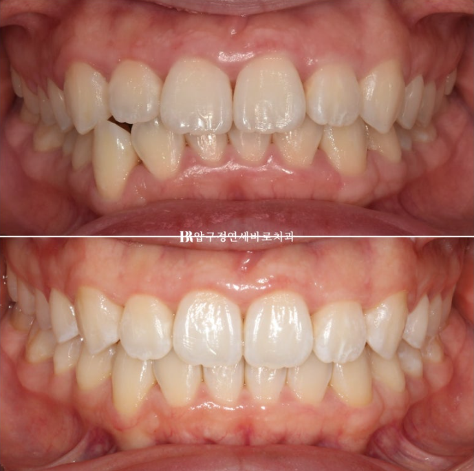 인비절라인 라이트 과개교합 반대교합 돌출입 뻐드렁니 교정 치료 관련 이미지 1