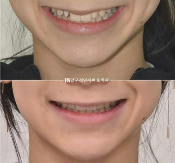 서울 인비절라인 덧니 교정 과개교합 후기 관련 이미지 10