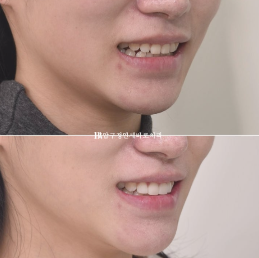 왜소치·원추형 치아, 교정보다 무삭제 라미네이트가 좋은 이유 | 앞니 벌어짐 치료 후기 관련 이미지 10