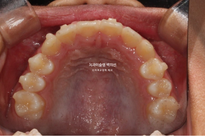 덧니 반대교합 과개교합 인비절라인 퍼스트 악궁확장 어린이 교정 치료 관련 이미지 8