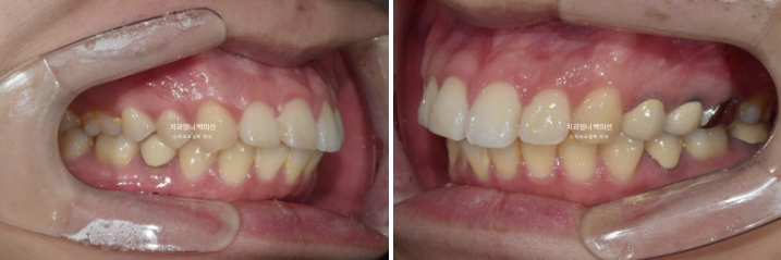 돌출입 발치 교정 인비절라인 후기 미니스크류 관련 이미지 3