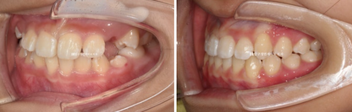 Simultaneous Arch Expansion and Teeth Alignment for Elementary School Children with Invisalign｜Invisalign First image 13