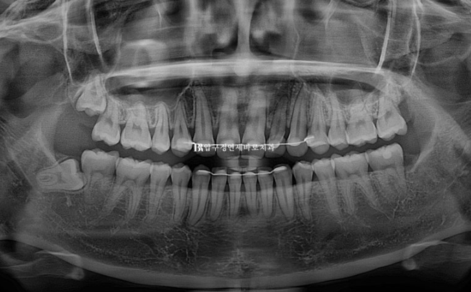 Actual Case of Treating Congenitally Missing and Peg-Shaped Teeth Without Implants image 20