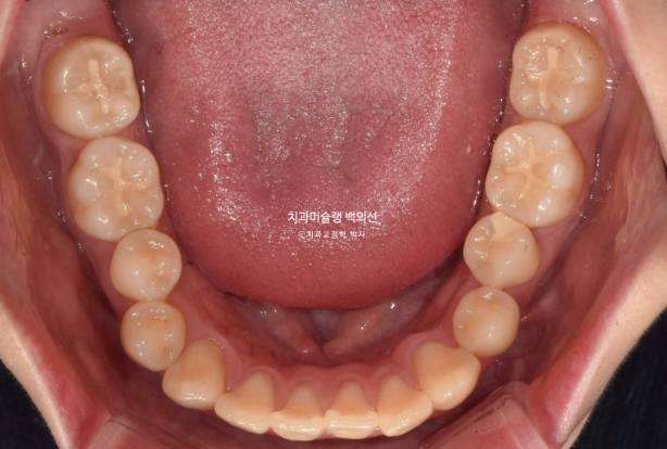 잇몸미소 인비절라인 거미스마일 토끼이빨 교정 무삭제 라미네이트 반대교합 치료 후기 관련 이미지 5