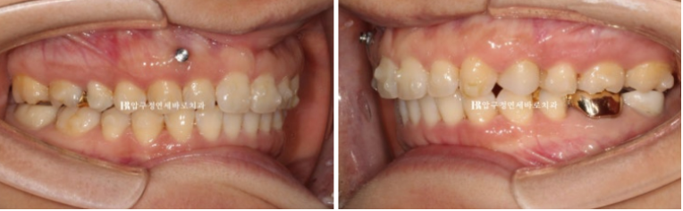 인비절라인 캔팅 교정 과개교합 교정 임플란트 재교정 관련 이미지 6