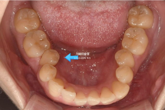 비발치 인비절라인 교정 편측 개방교합 가위교합 돌출 재교정 관련 이미지 6