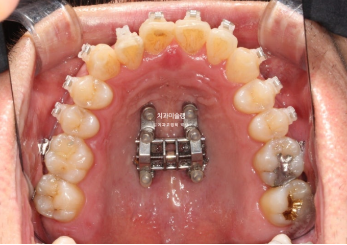 30대 MSE 악궁확장 덧니 반대교합 비발치 클리피씨 부작용 관련 이미지 11